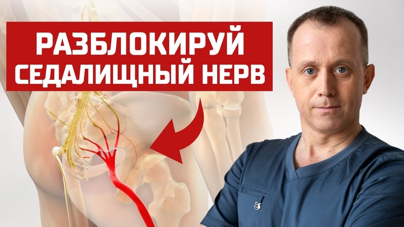 Защемление седалищного нерва ЧТО ДЕЛАТЬ 9 шагов от боли в