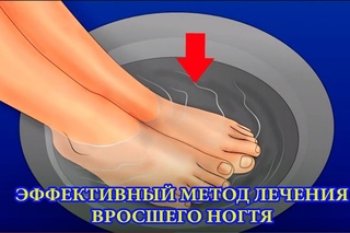 вросший ноготь! Проблема решена!