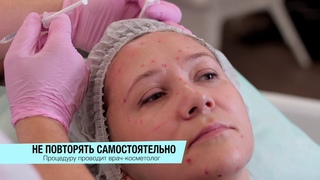 Ботулинотерапия препаратом ксеомин, в технике фулфейс