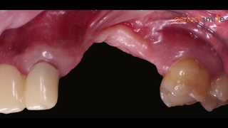 Bone grafting of totaly atrophic maxilla