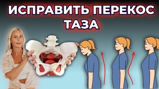 Нижний перекрестный синдром. Почему торчит живот? Перекос таза