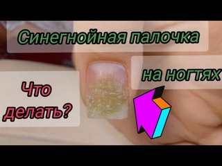 ЧТО ДЕЛАТЬ с псевдомонией на ногтях? Простые и эффективные советы