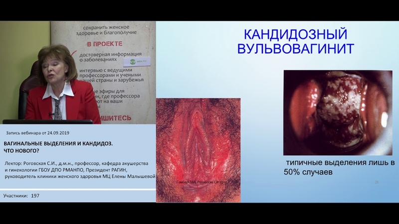 Вагинальные выделения и кандидоз. Что
