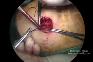 Single incision laparoscopic surgery using common laparoscopic instruments