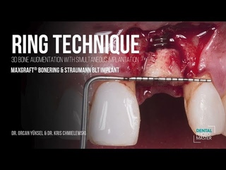 Bone Ring Technique surgery