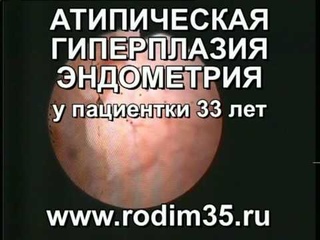 Атипическая гиперплазия эндометрия. Гистероскопия.